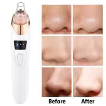 Extractor de impurezas y puntos negros